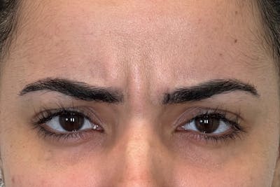Dysport Before & After Gallery - Patient 168374 - Image 1