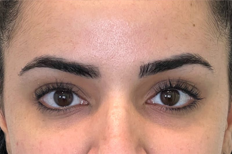 Dysport Before & After Gallery - Patient 168374 - Image 6
