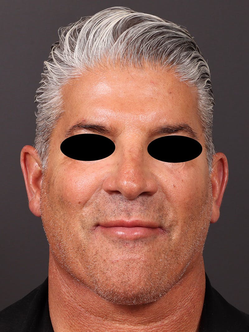 Neck Lift Before & After Gallery - Patient 417192 - Image 2