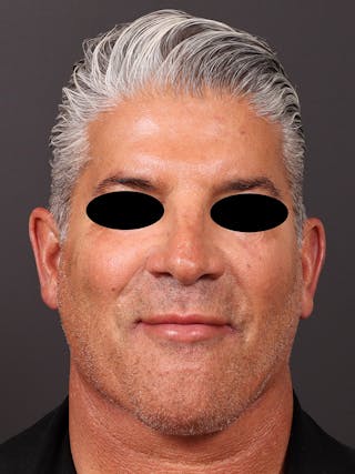 Neck Lift Before & After Gallery - Patient 417192 - Image 2