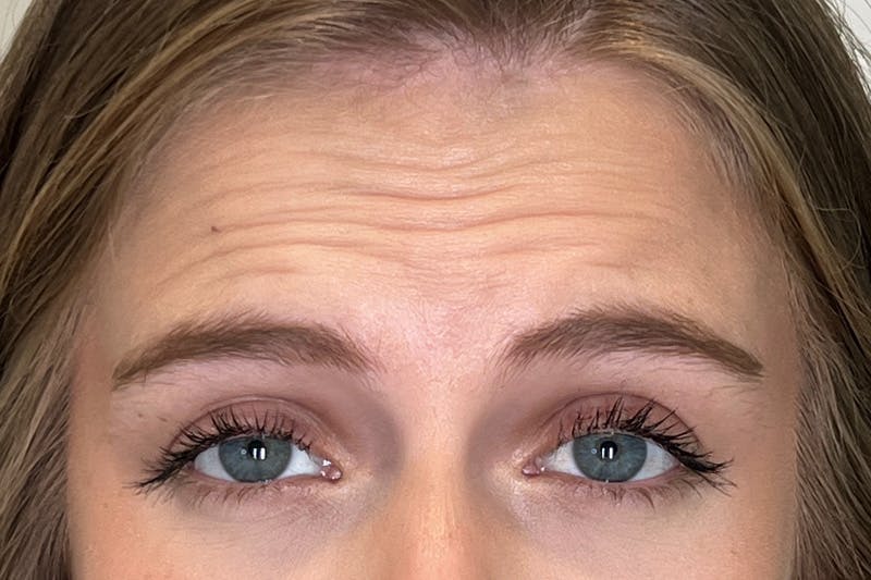 BOTOX Before & After Gallery - Patient 913658 - Image 3