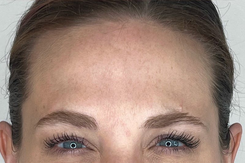 BOTOX Before & After Gallery - Patient 283220 - Image 4