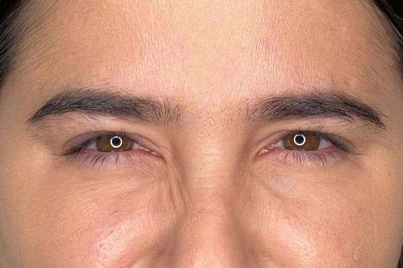 Dysport Before & After Gallery - Patient 310845 - Image 2