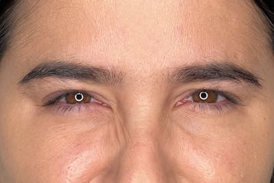 Dysport Before & After Gallery - Patient 310845 - Image 2
