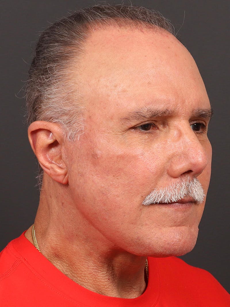 Facelift Before & After Gallery - Patient 557057 - Image 4