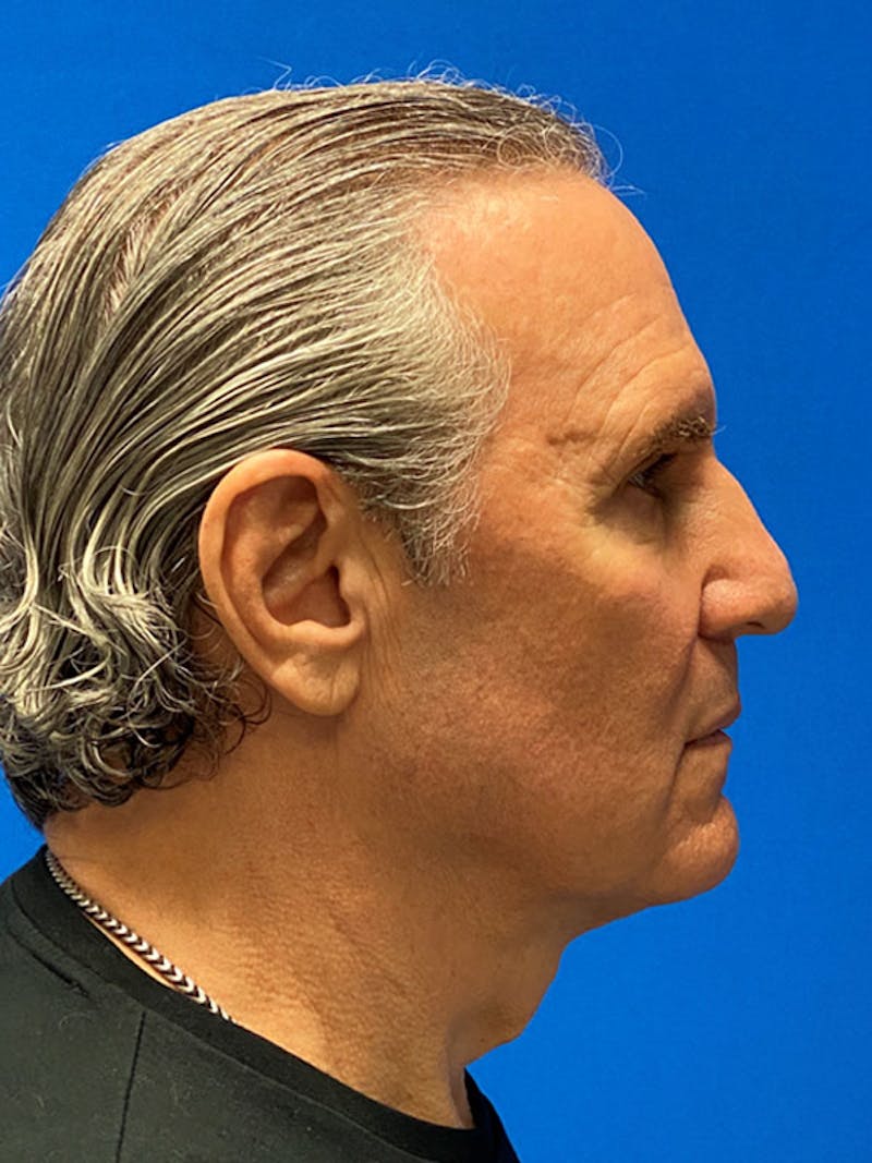 Facelift Before & After Gallery - Patient 359956 - Image 5