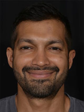 Male Face & Neck Before & After Gallery - Patient 452117 - Image 2