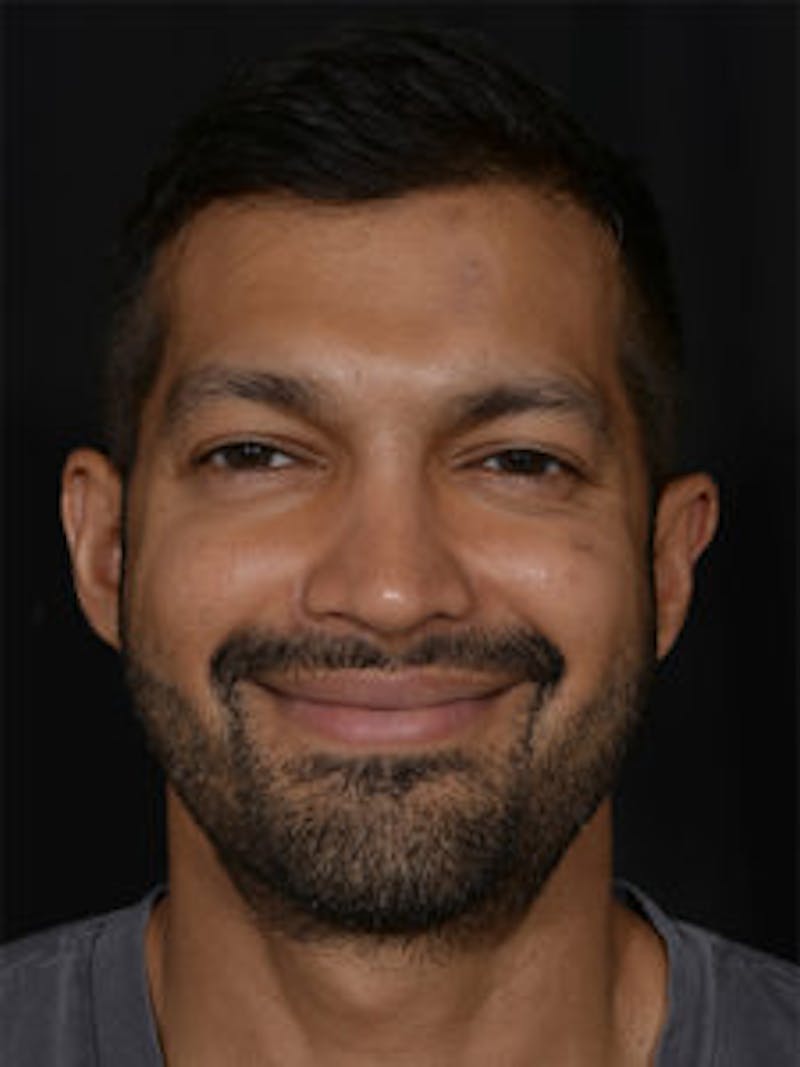 Male Face & Neck Before & After Gallery - Patient 452117 - Image 2