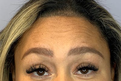 BOTOX Before & After Gallery - Patient 175021 - Image 1