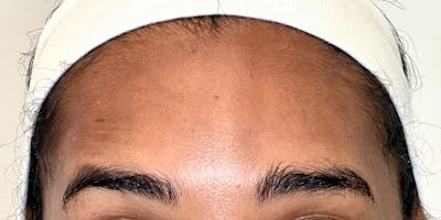 Dysport Before & After Gallery - Patient 189508 - Image 2