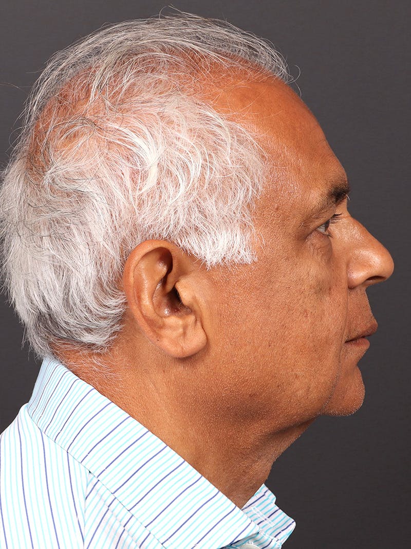 Male Face & Neck Before & After Gallery - Patient 114462 - Image 5