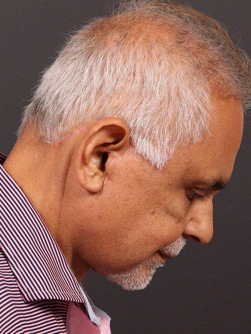Male Face & Neck Before & After Gallery - Patient 114462 - Image 8