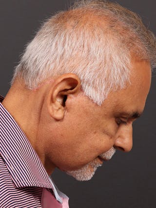 Male Face & Neck Before & After Gallery - Patient 114462 - Image 8