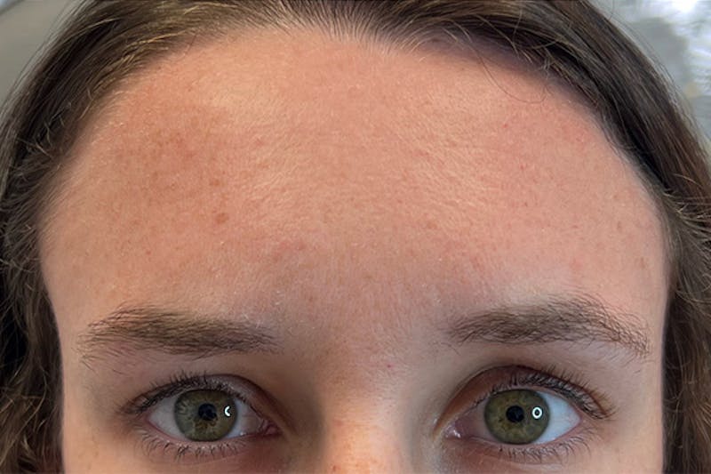 Dysport Before & After Gallery - Patient 182212 - Image 2