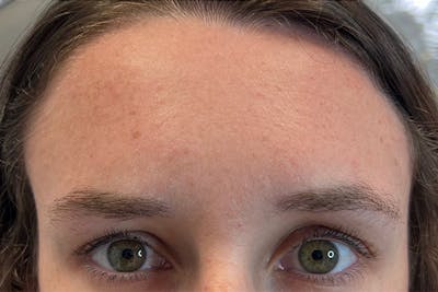 Dysport Before & After Gallery - Patient 182212 - Image 2