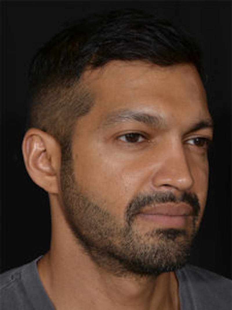 Male Face & Neck Before & After Gallery - Patient 452117 - Image 4