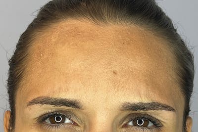 BOTOX Before & After Gallery - Patient 149423 - Image 2