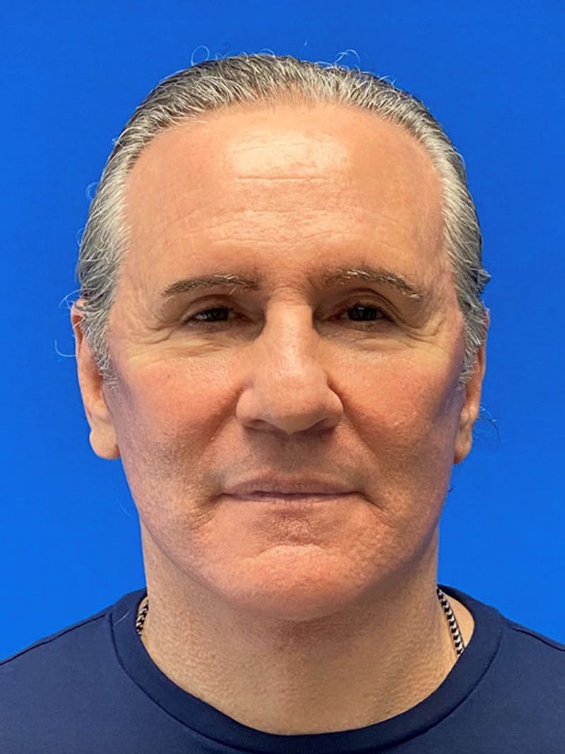 Facelift Before & After Gallery - Patient 359956 - Image 2