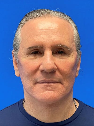 Male Face & Neck Before & After Gallery - Patient 333373 - Image 2