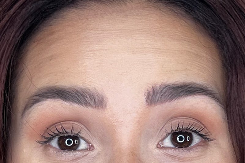 Dysport Before & After Gallery - Patient 116764 - Image 1