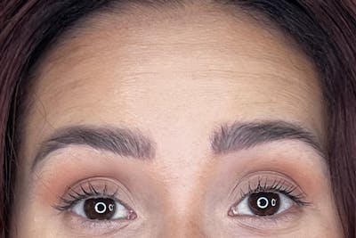 Dysport Before & After Gallery - Patient 116764 - Image 1