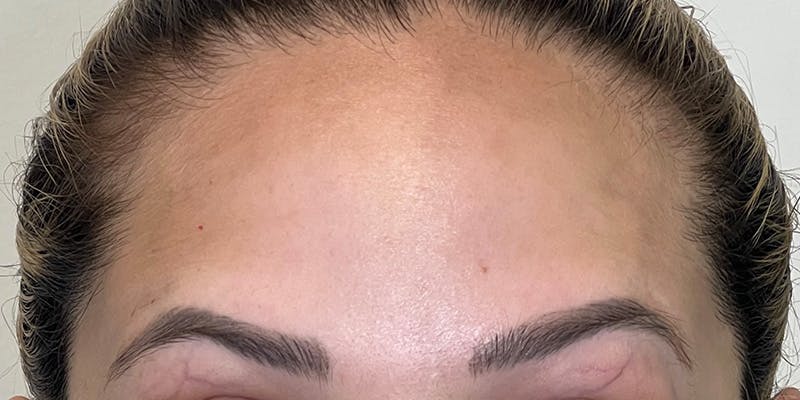 Dysport Before & After Gallery - Patient 258329 - Image 2