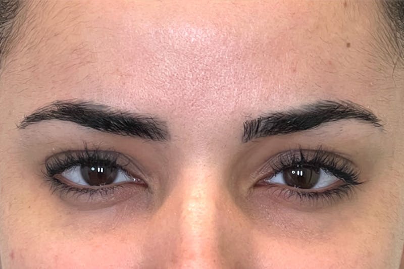 Dysport Before & After Gallery - Patient 168374 - Image 2