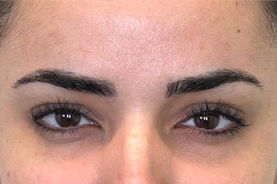 Dysport Before & After Gallery - Patient 168374 - Image 2