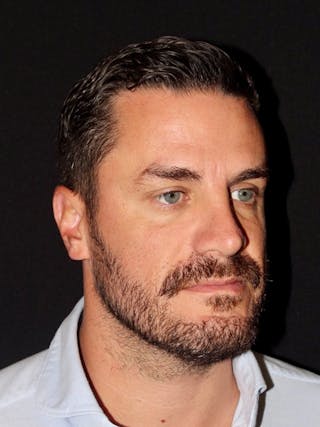 Male Face & Neck Before & After Gallery - Patient 114598 - Image 4