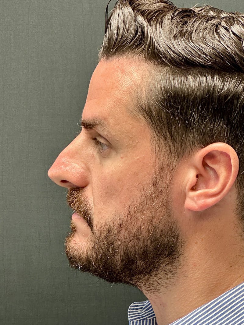 Male Face & Neck Before & After Gallery - Patient 114598 - Image 5