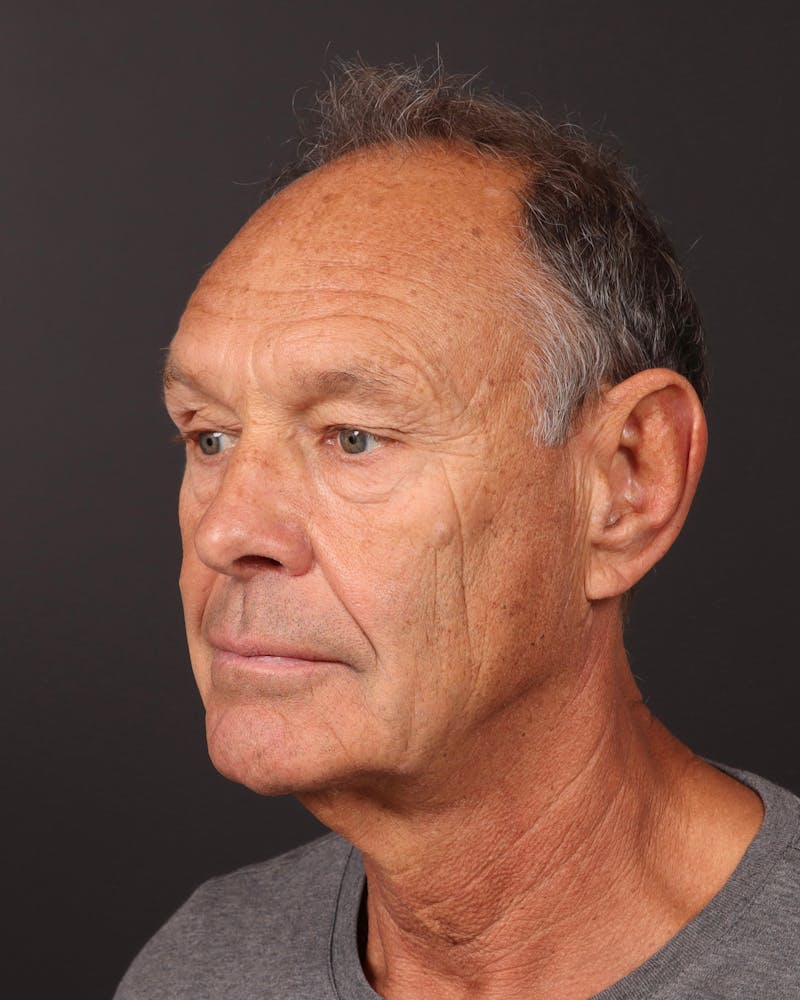 Facelift Before & After Gallery - Patient 501762 - Image 1