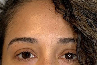 BOTOX Before & After Gallery - Patient 144247 - Image 1