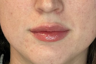 Lip Filler Before & After Gallery - Patient 635279 - Image 2