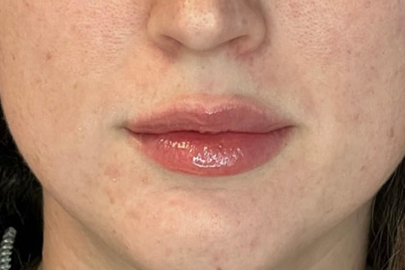 Lip Filler Before & After Gallery - Patient 309324 - Image 2