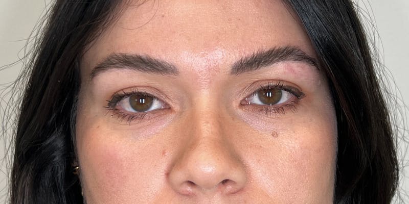 Dysport Before & After Gallery - Patient 192220 - Image 1