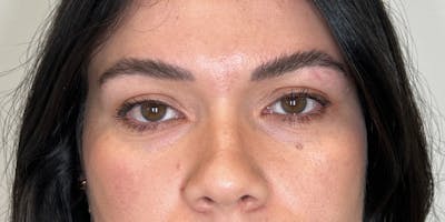 Dysport Before & After Gallery - Patient 192220 - Image 1