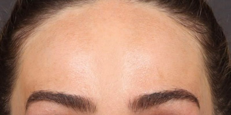 Dysport Before & After Gallery - Patient 255060 - Image 2