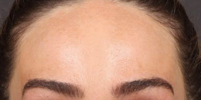 Dysport Before & After Gallery - Patient 255060 - Image 2