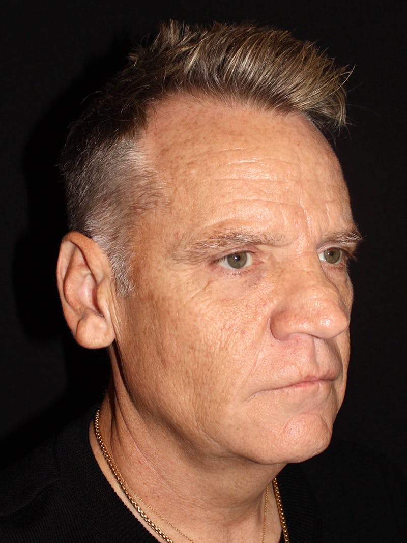 Facelift Before & After Gallery - Patient 345523 - Image 3