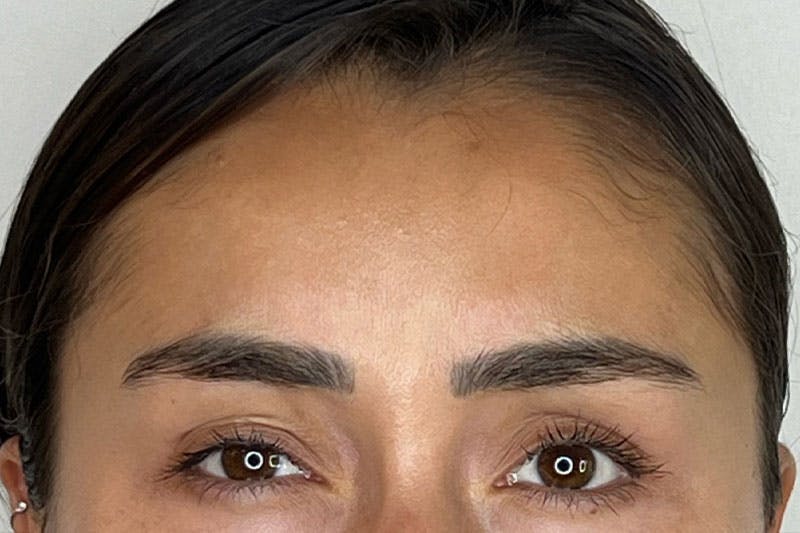 BOTOX Before & After Gallery - Patient 344438 - Image 4