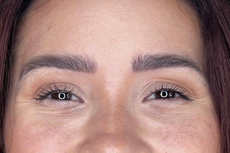 Dysport Before & After Gallery - Patient 116764 - Image 7