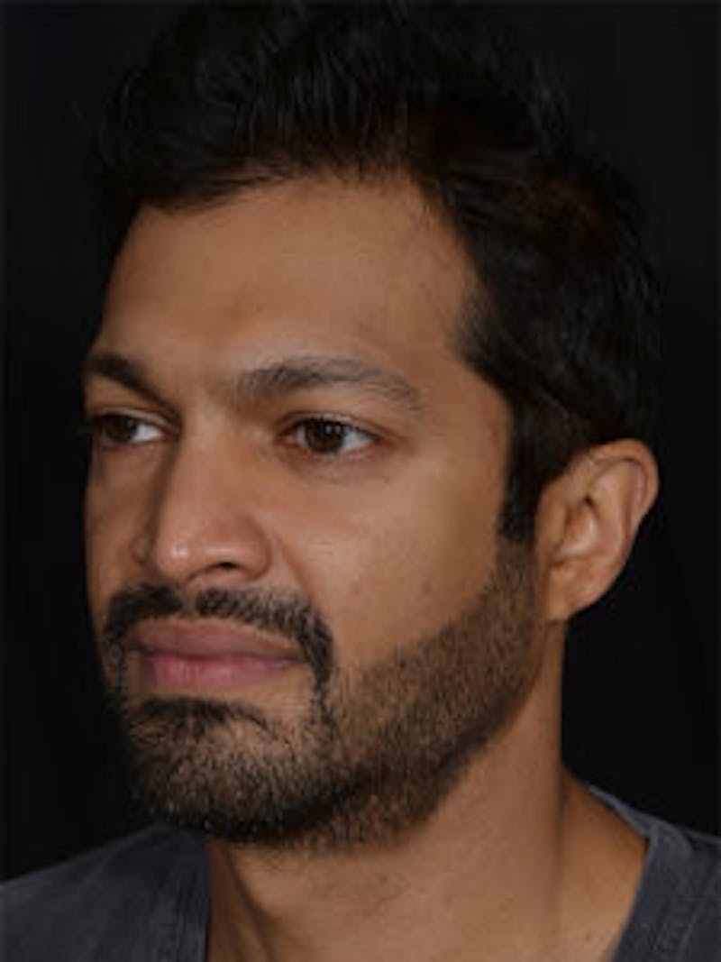 Male Face & Neck Before & After Gallery - Patient 452117 - Image 7