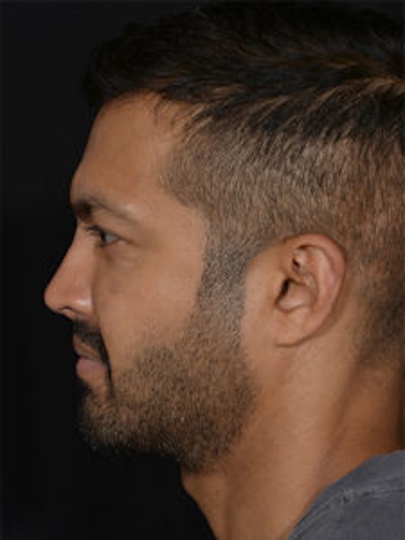 Male Face & Neck Before & After Gallery - Patient 452117 - Image 10