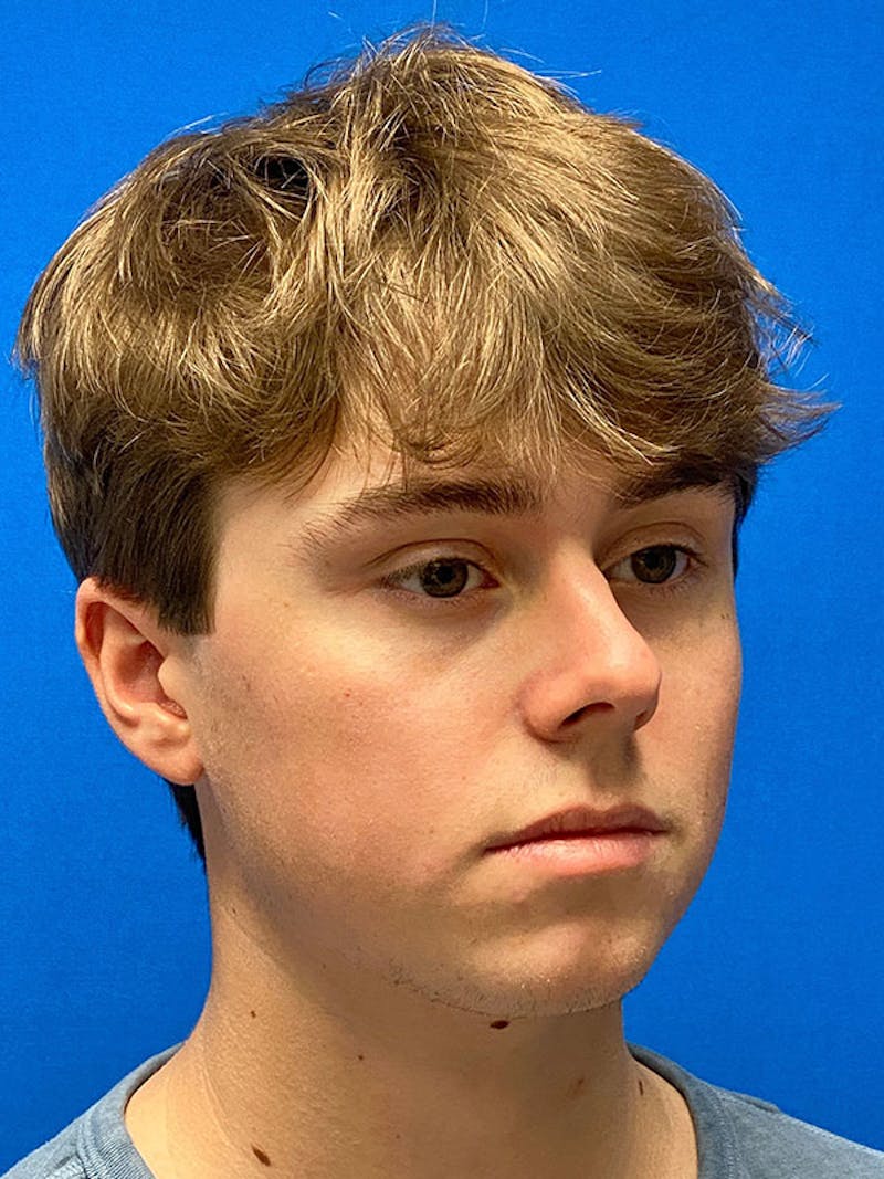 Male Face & Neck Before & After Gallery - Patient 191830 - Image 3