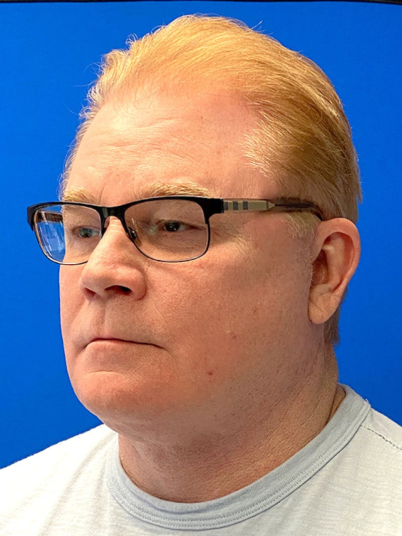 Facelift Before & After Gallery - Patient 153770 - Image 6