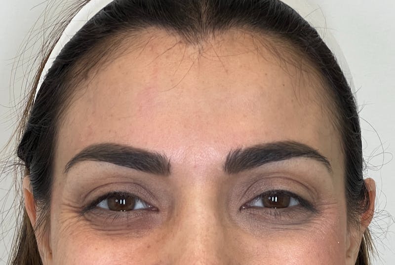 Dysport Before & After Gallery - Patient 309774 - Image 3