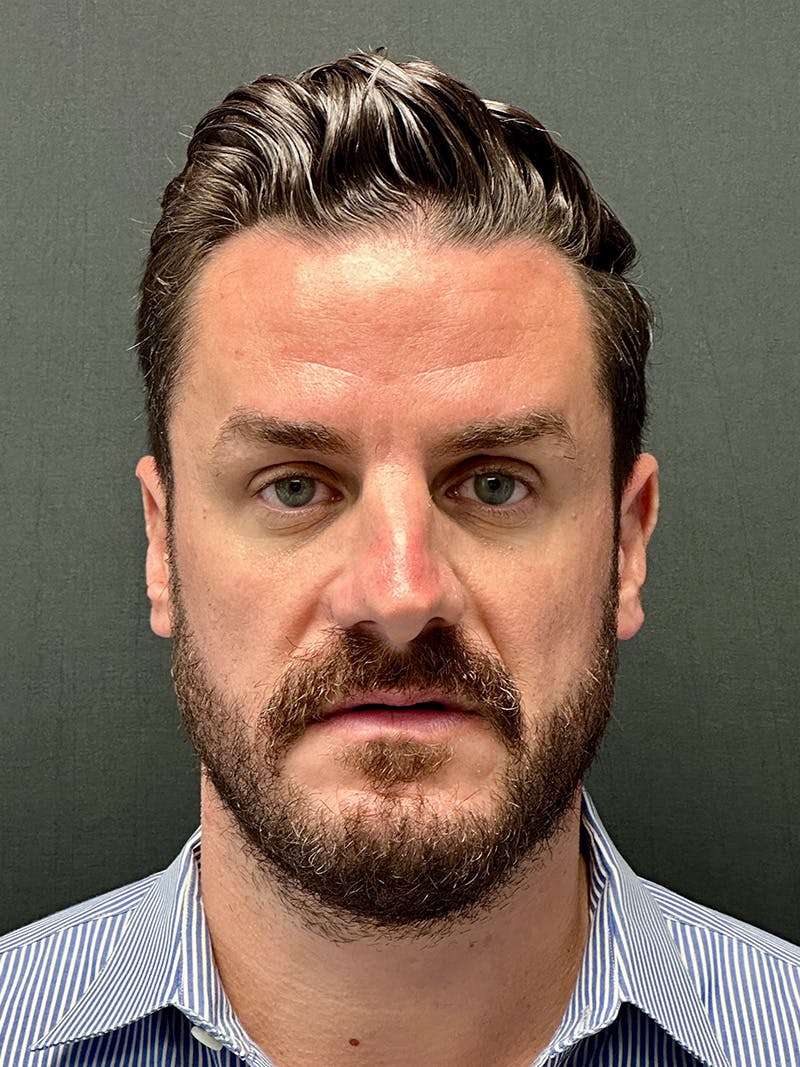 Male Face & Neck Before & After Gallery - Patient 114598 - Image 1