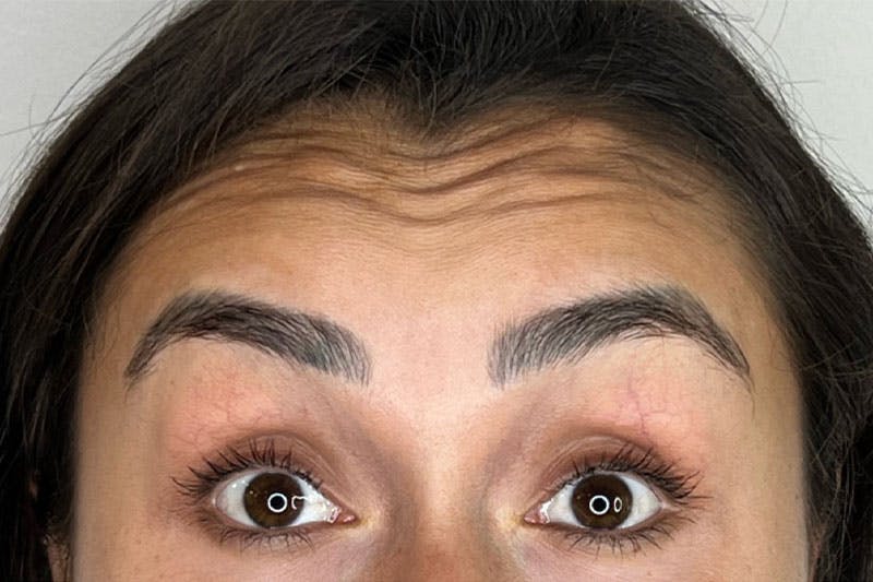 BOTOX Before & After Gallery - Patient 344438 - Image 1