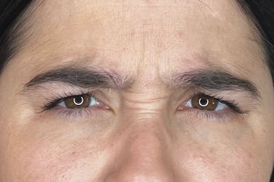 Dysport Before & After Gallery - Patient 310845 - Image 1