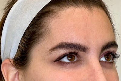 BOTOX Before & After Gallery - Patient 344936 - Image 1